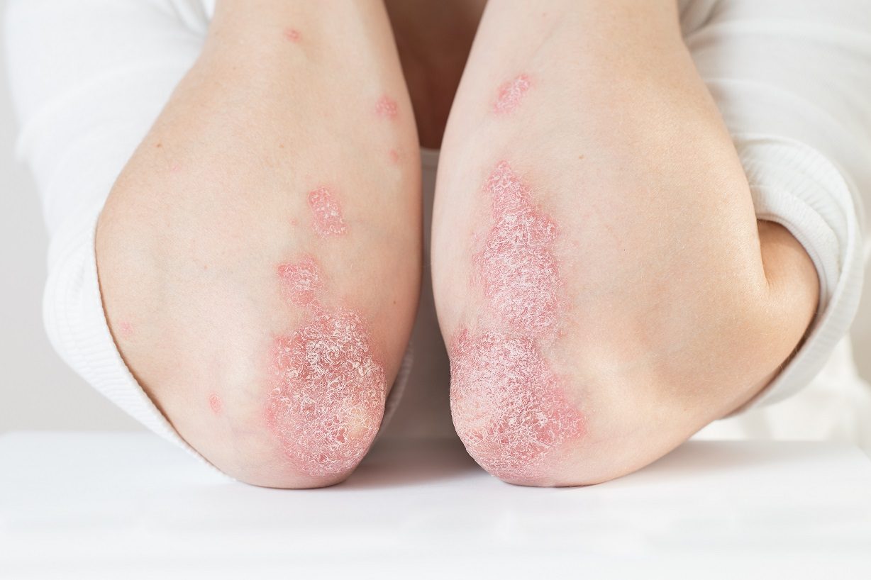 Psoriasis behandeln Mikroimmuntherapie