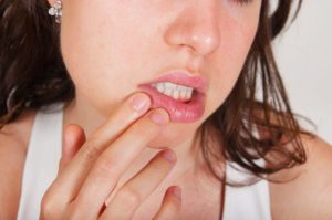 Herpes frühzeitig entgegen wirken