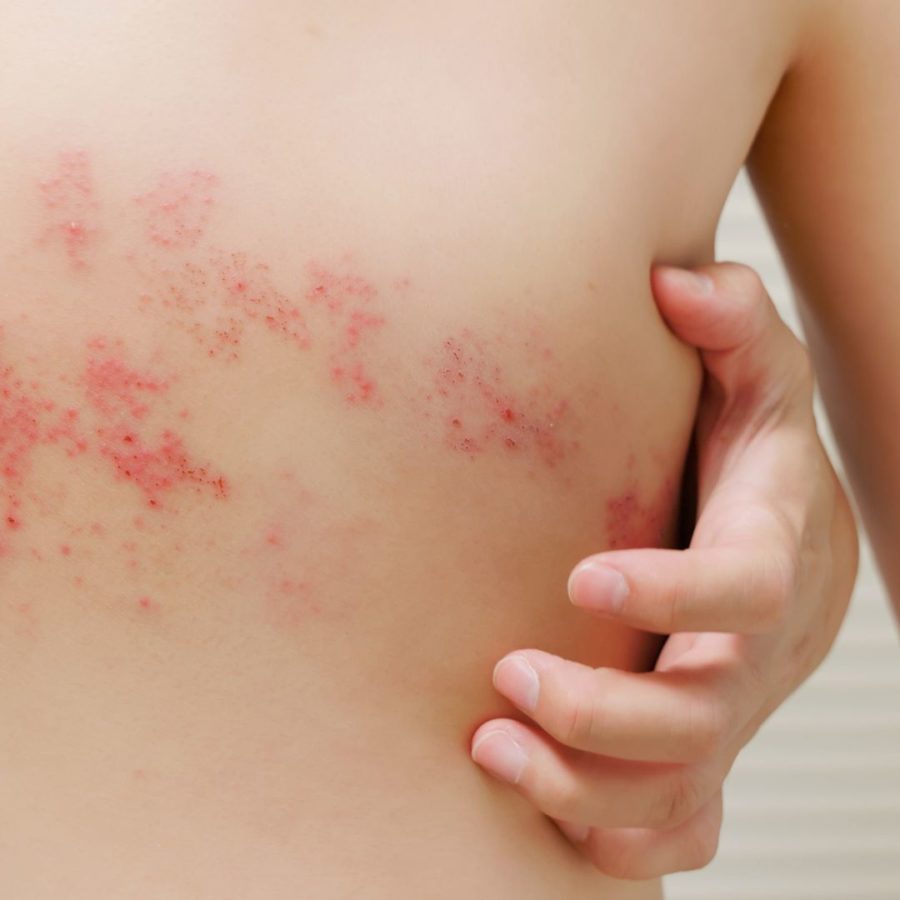 Gürtelrose ansteckend