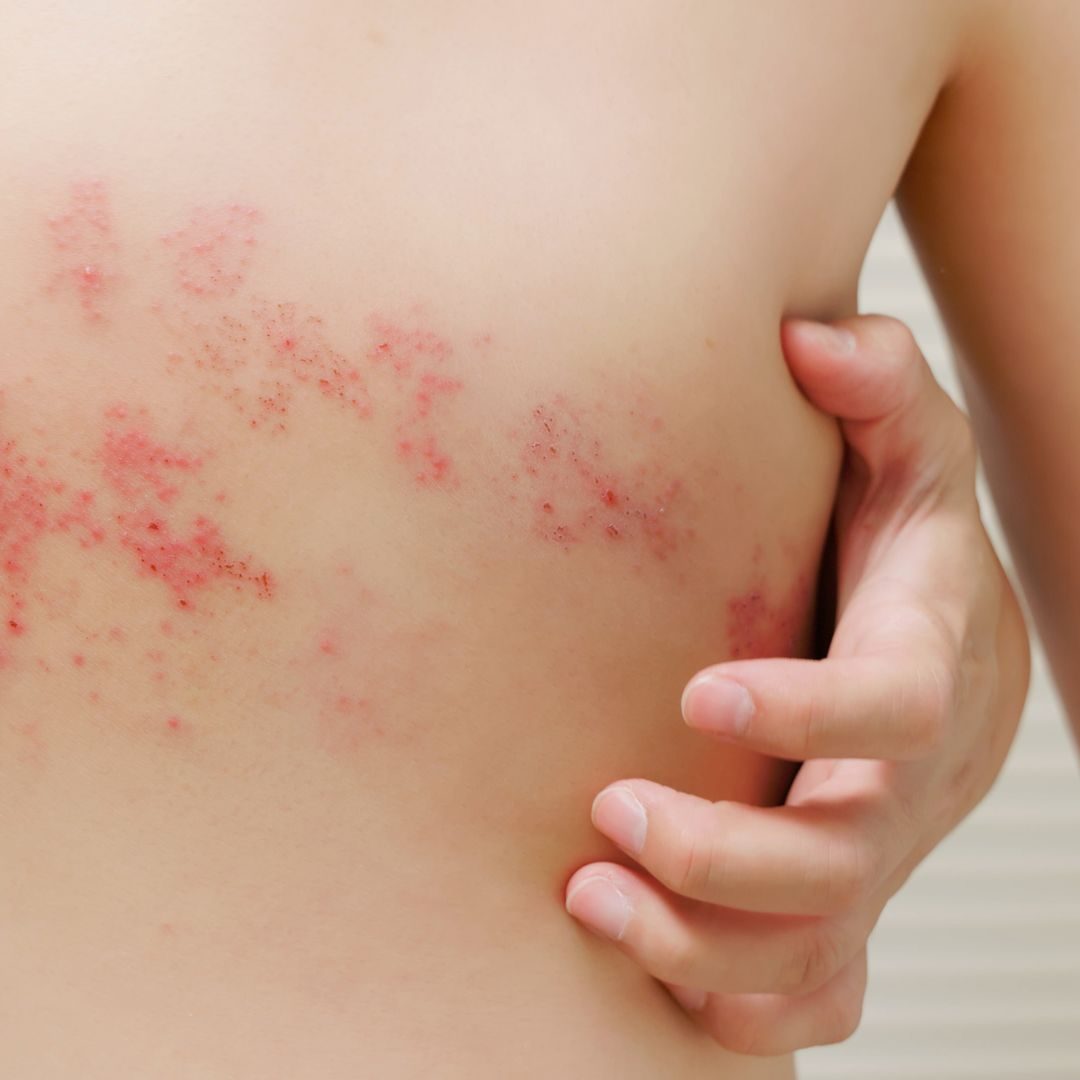 Gürtelrose ansteckend